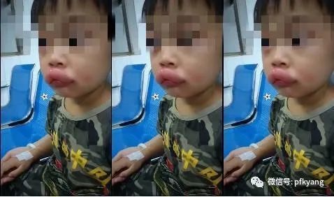 男孩吃葡萄過敏腫成嘟嘟嘴怎么回事？畫面詳情曝光網(wǎng)友忍不住笑了