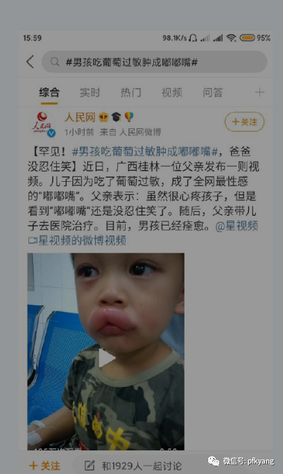 男孩吃葡萄過敏腫成嘟嘟嘴怎么回事？畫面詳情曝光網(wǎng)友忍不住笑了(圖3)